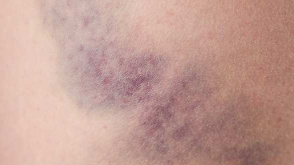 Inre blödningar: orsak, symtom & behandling